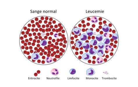 subtipuri de leucemie hepatocelulară de leucemie
